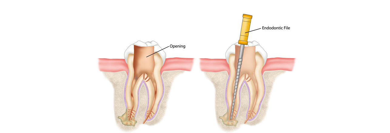 Root Canal Treatment in Etobicoke
